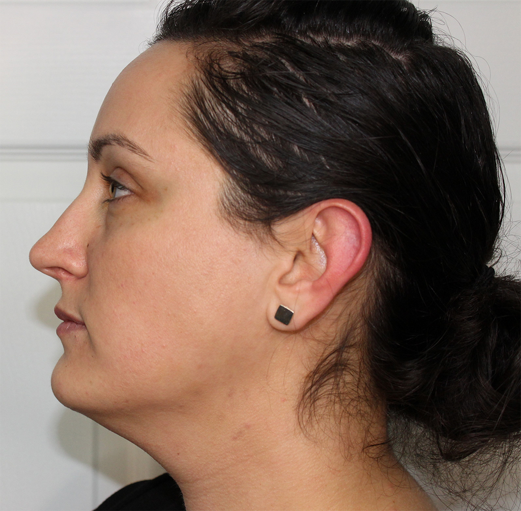 Image showing Brooke after her treatment