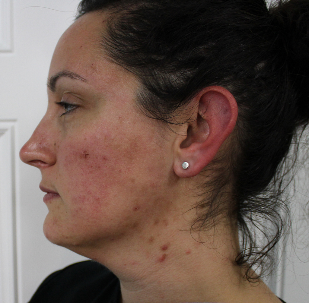 Image showing Brooke before her treatment.